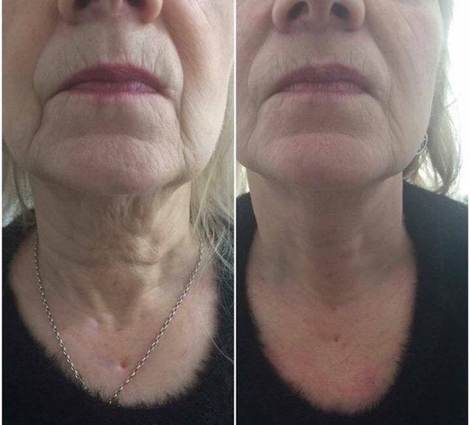 Before and after of a HIFU face lift on a mature client with visibly tighter jawline.