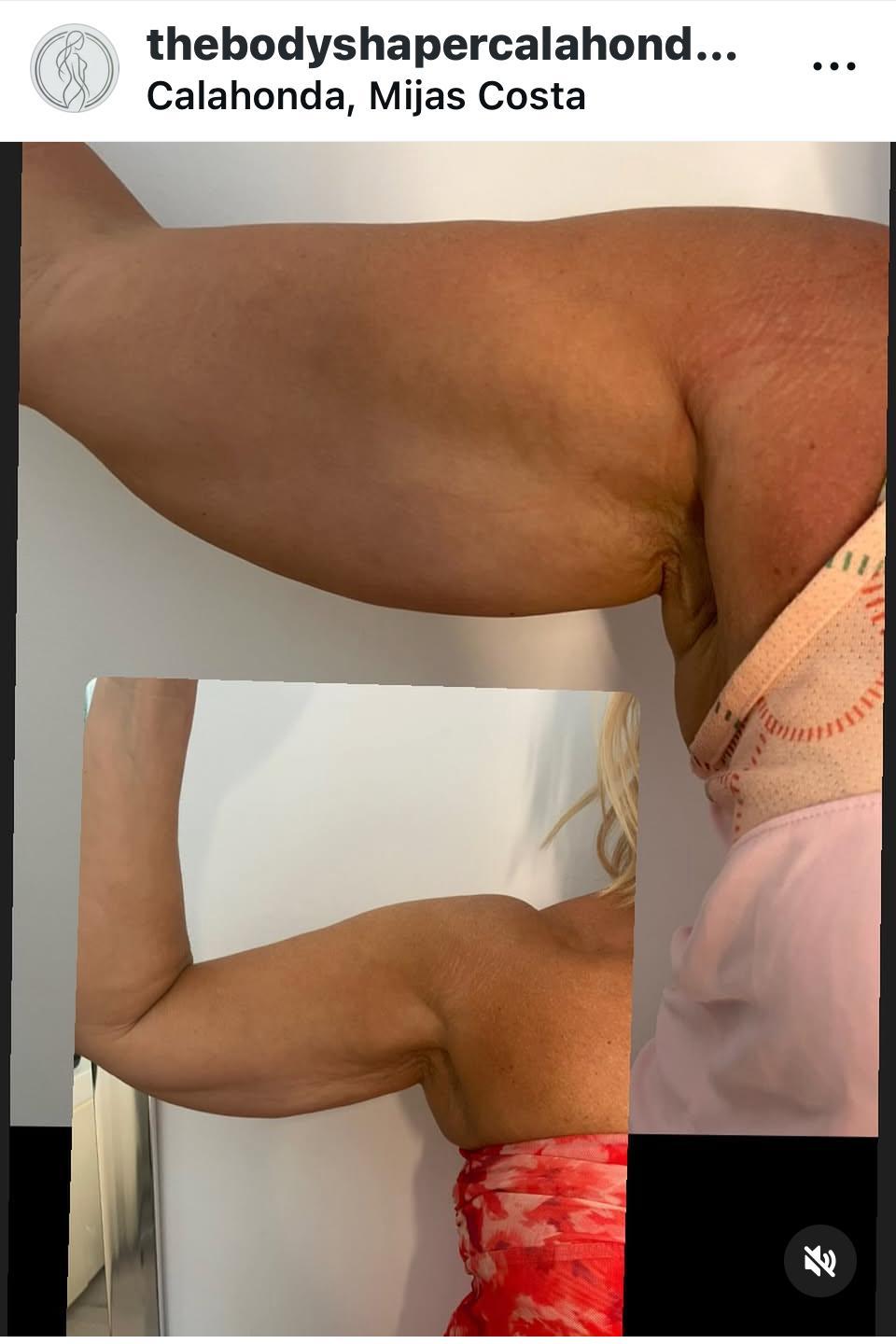 Before and after of a HIFU arms treatment on a mature client with visibly tighter inner arm skin.