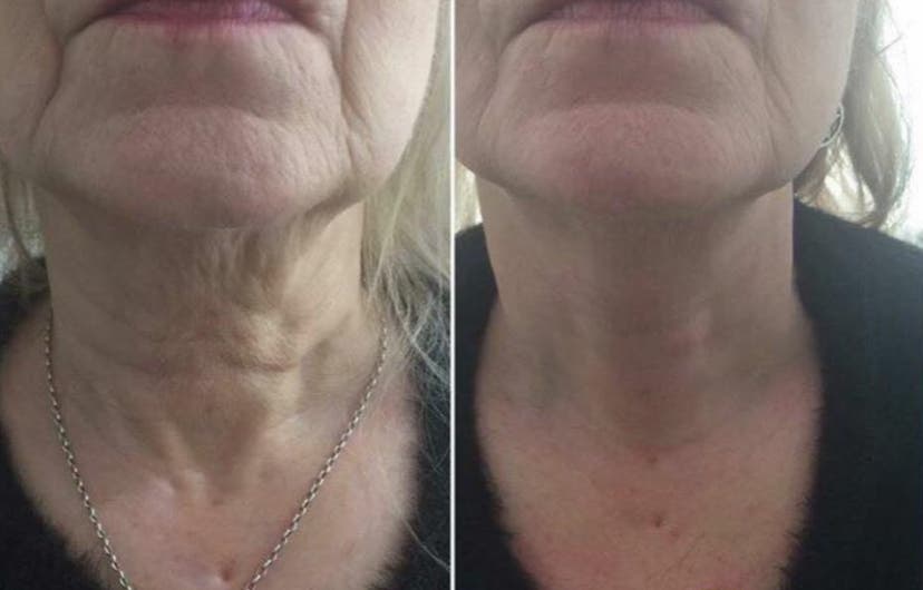 Before and after of a HIFU double chin reduction treatment at The Body Shaper Calahonda showing a smoother neckline.